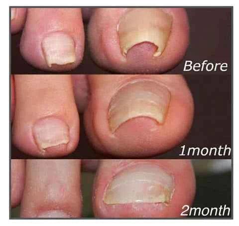 Fungal Nail Patches