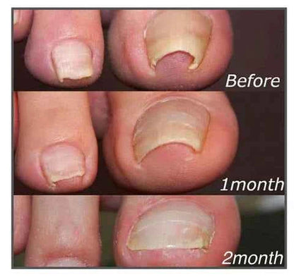 Fungal Nail Patches