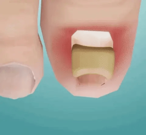 Fungal Nail Patches