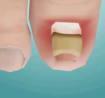 Fungal Nail Patches
