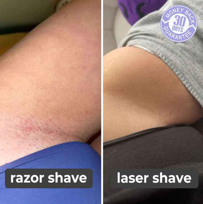 Laser Hair Remover for Smooth, Effortless Hair Removal at Home