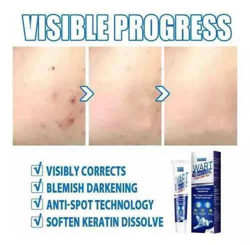 Instant Herbal Wart Remover Cream(100g)